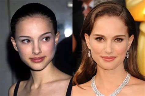 natalie portman facelift.